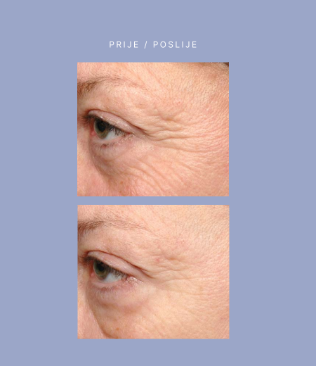 AFRODITA PROFESSIONAL PERFECT CODE Filler-drops koncentrat BIH